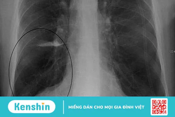 Tìm hiểu các xét nghiệm giúp chẩn đoán COPD