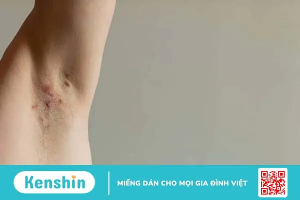 Tìm hiểu chi tiết về viêm da mủ để điều trị đúng, hiệu quả