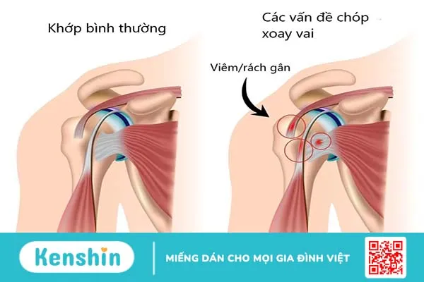 Tìm hiểu nguyên nhân vì sao bạn bị đau khớp vai