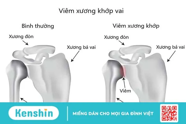 Tìm hiểu nguyên nhân vì sao bạn bị đau khớp vai