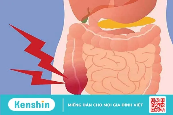 Tìm hiểu nhanh về viêm ruột thừa mãn tính