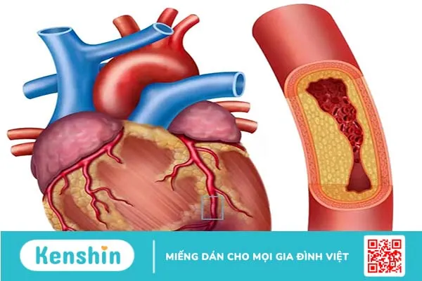 Tìm hiểu về các biến chứng mạch máu lớn của bệnh tiểu đường