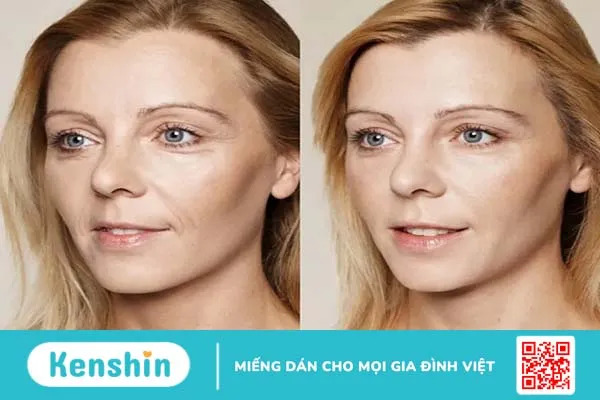 Tìm hiểu về chất làm đầy da Restylane và Botox