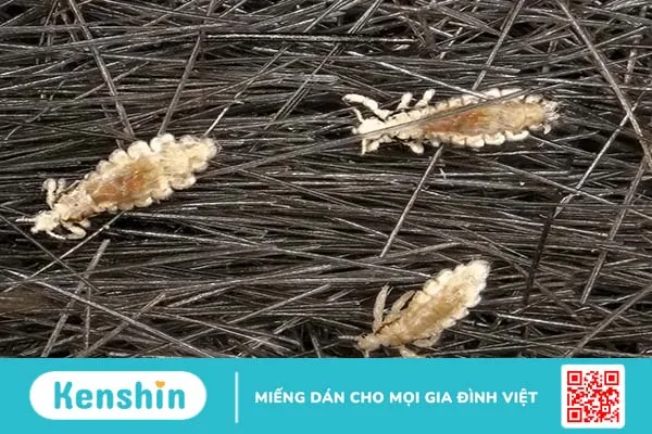 Tìm hiểu về hiện tượng mẹ bầu nhiễm chấy khi mang thai