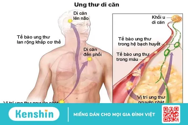 Tìm hiểu về ung thư phổi do tế bào ung thư di căn đến phổi