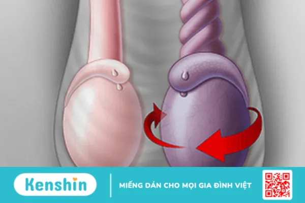 Tinh hoàn nhỏ có bị vô sinh không? Nguyên nhân, cách trị tinh hoàn nhỏ