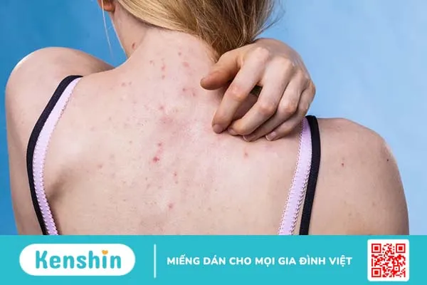 Tổng hợp 6 sản phẩm trị mụn lưng tại nhà và cách sử dụng