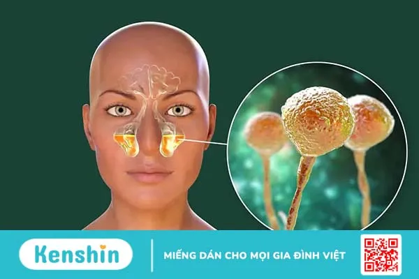 Tổng quan về các loại viêm xoang thường gặp và cách phân biệt