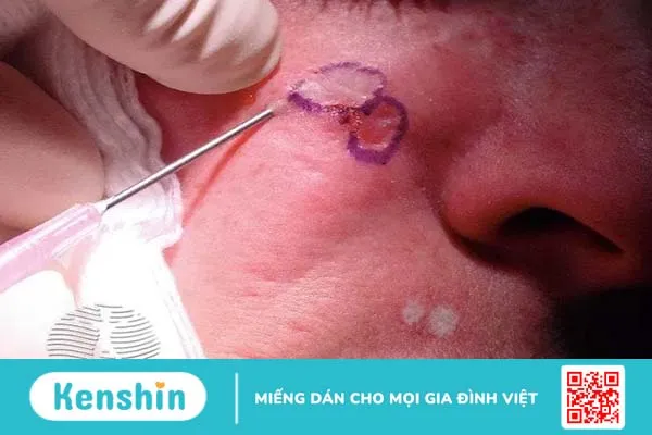 Top 5 cách trị sẹo rỗ chuẩn y khoa