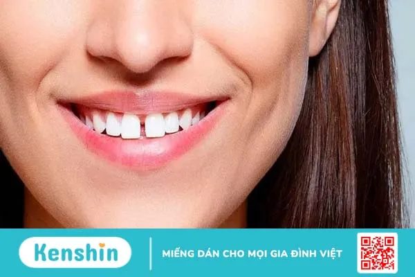 Trám răng là gì? Quy trình trám răng diễn ra như thế nào?