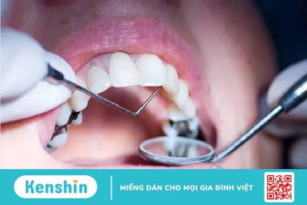 Trám răng là gì? Quy trình trám răng diễn ra như thế nào?