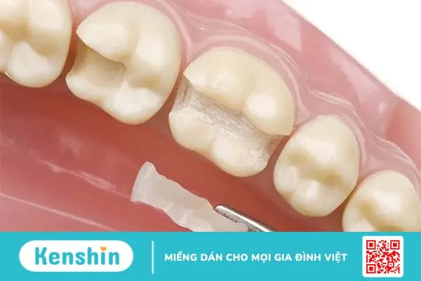 Trám răng là gì? Quy trình trám răng diễn ra như thế nào?