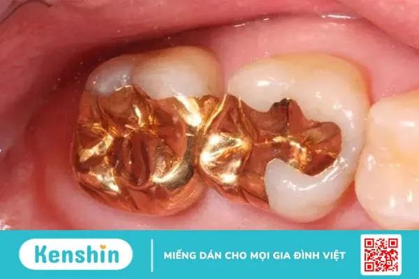 Trám răng là gì? Quy trình trám răng diễn ra như thế nào?