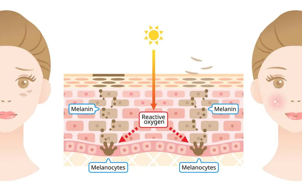 Tranexamic acid là gì? Cách sử dụng điều trị nám da, thâm mụn