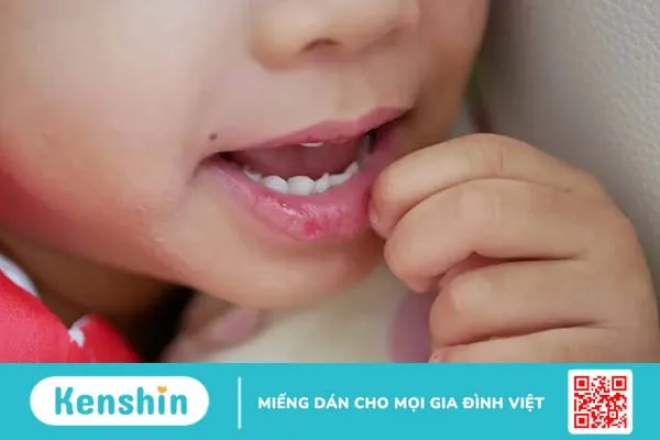 Trẻ bị khô môi thiếu chất gì? Cách trị môi khô nứt nẻ tại nhà cho bé