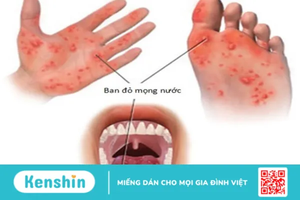 Trẻ bị tay chân miệng bao lâu thì khỏi? Mẹo giúp bé mau khỏi bệnh