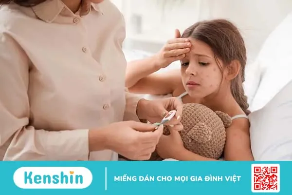 Trẻ bị thủy đậu kiêng ăn gì? Điểm danh 7 thực phẩm cần tránh xa