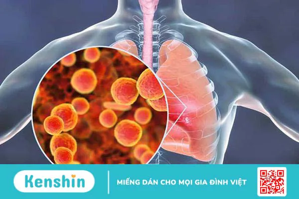 Trẻ bị viêm phổi nặng do vi khuẩn Mycoplasma: Những thông tin cần biết!