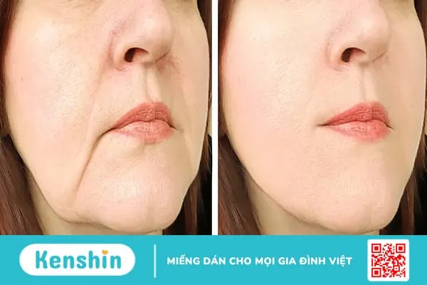 Trẻ hóa bằng cách cấy mỡ mặt có an toàn và lâu dài không?