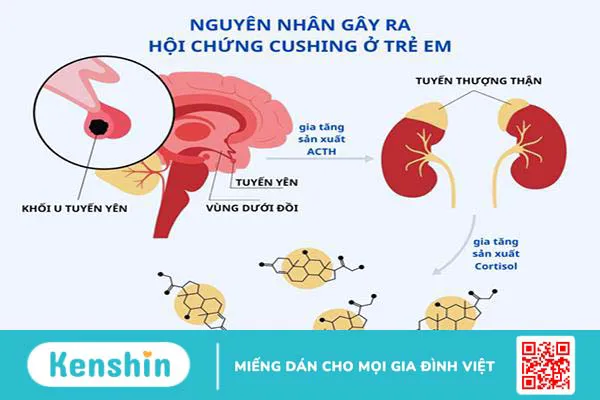 Trẻ thừa cân, béo phì hay đang mắc hội chứng Cushing ở trẻ em?