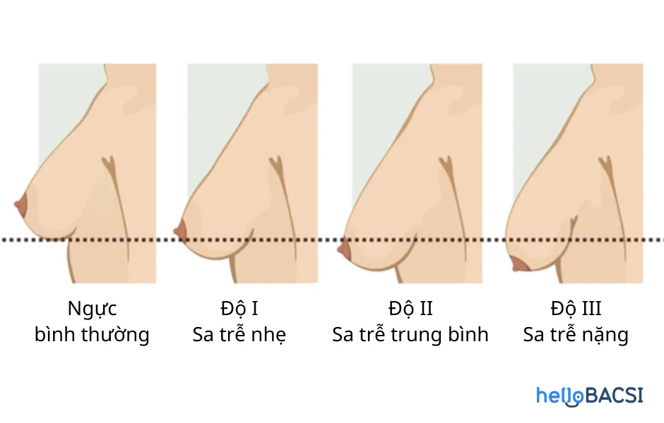 Treo sa trễ là gì? 8 điều phải biết trước khi quyết định phẫu thuật