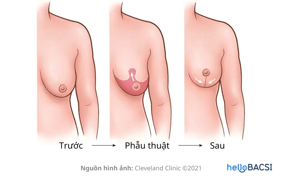 Treo sa trễ là gì? 8 điều phải biết trước khi quyết định phẫu thuật