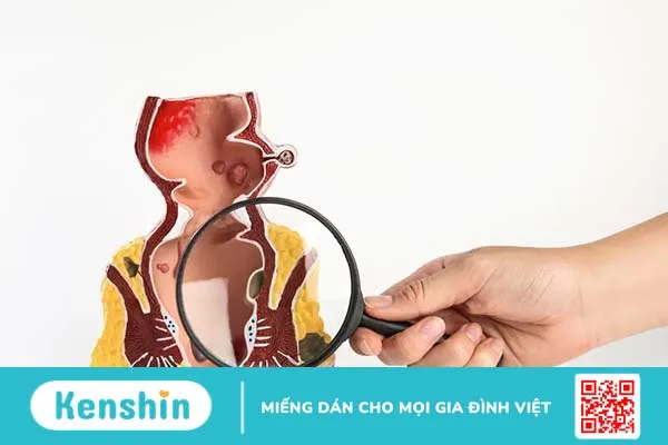 Trĩ ngoại độ 1