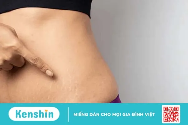 Trị rạn da bằng dầu ô liu giúp bạn lấy lại làn da căng bóng