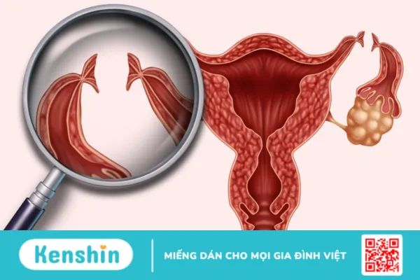 Triệt sản sau sinh mổ có gây rủi ro? Tìm hiểu để không lo lắng!