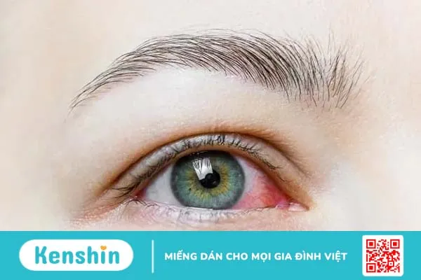 Triệu chứng bệnh đau mắt đỏ, sự lây nhiễm, cách chăm sóc & điều trị