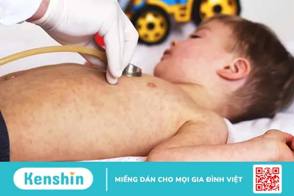 Triệu chứng bệnh sởi theo từng giai đoạn và cách ngừa bệnh lây lan