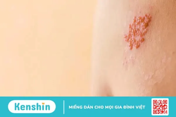 Triệu chứng các bệnh về da phổ biến ở người lớn và trẻ em