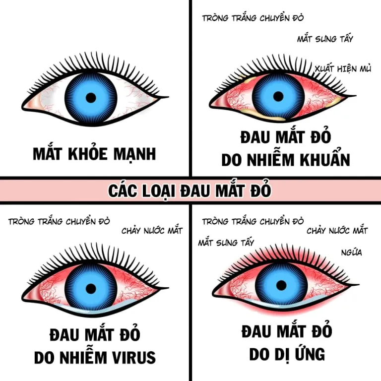 Triệu chứng đau mắt đỏ khác nhau ở mỗi người, tùy vào nguyên nhân