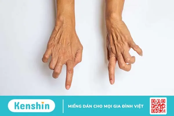 Triệu chứng động kinh: Nhận diện các dạng điển hình