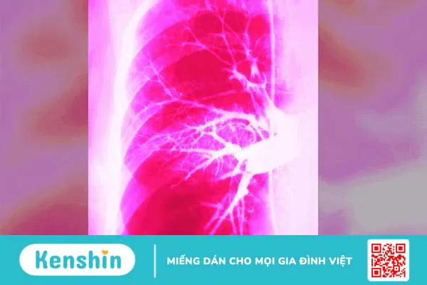 Triệu chứng khó thở hụt hơi là bệnh gì? Cách khắc phục