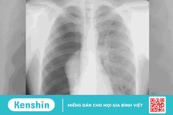 Triệu chứng khó thở hụt hơi là bệnh gì? Cách khắc phục