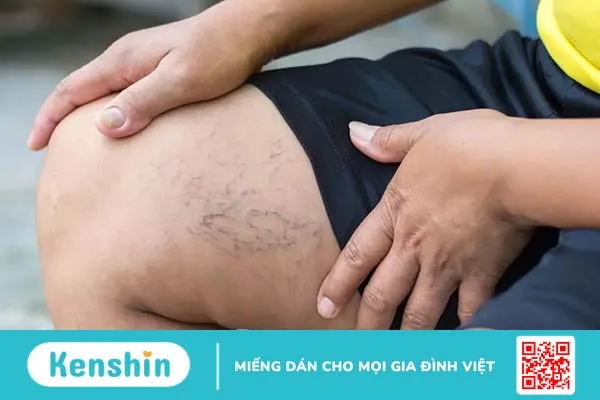 Triệu chứng suy giãn tĩnh mạch biểu hiện như thế nào?