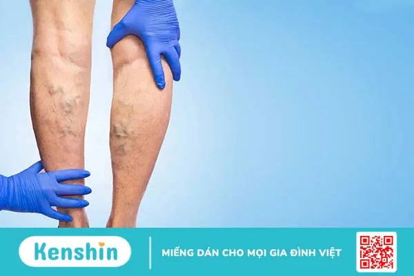 Triệu chứng suy giãn tĩnh mạch biểu hiện như thế nào?