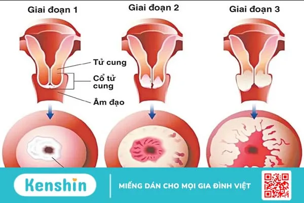 Triệu chứng ung thư cổ tử cung giai đoạn đầu là gì?