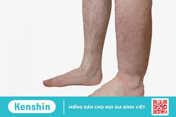 Triệu chứng xơ gan giai đoạn cuối: “Thông điệp” từ tử thần