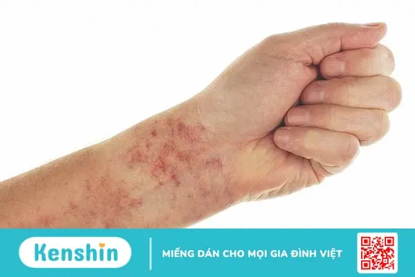 Triệu chứng xơ gan giai đoạn cuối: “Thông điệp” từ tử thần