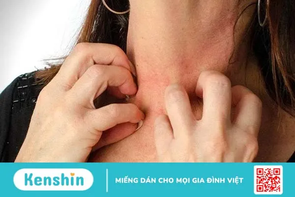 Trời lạnh bị ngứa có nguy hiểm không, điều trị và phòng ngừa ra sao?