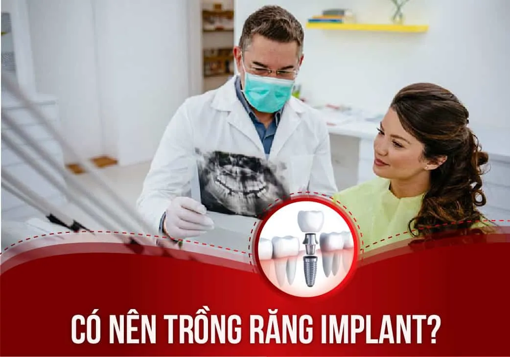 Trồng răng Implant: Lời khuyên từ bác sĩ!