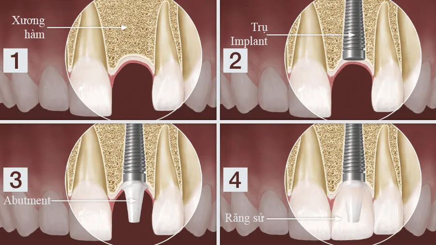 Trồng răng Implant: Lời khuyên từ bác sĩ!