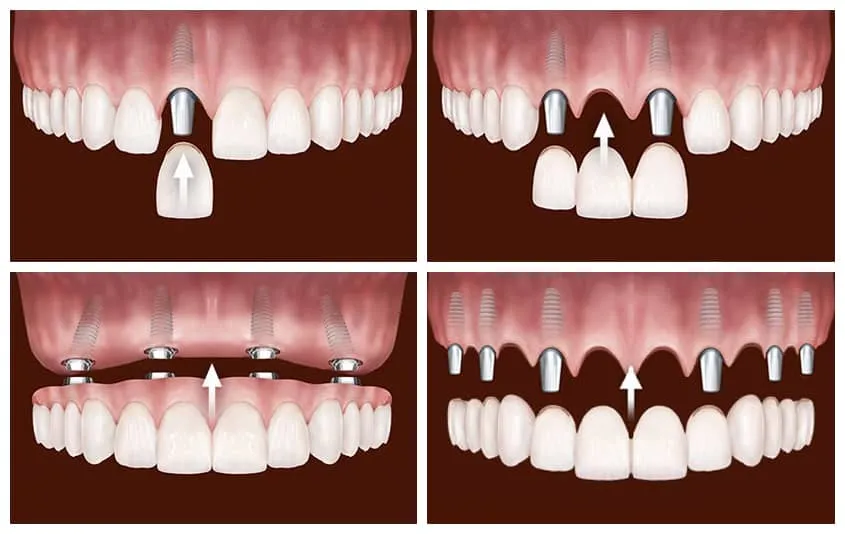 Trồng răng Implant: Lời khuyên từ bác sĩ!