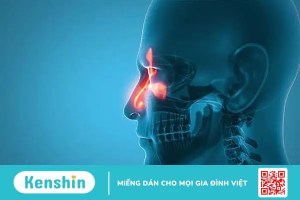 Truy tìm nguyên nhân nghẹt mũi nhưng không chảy nước mũi