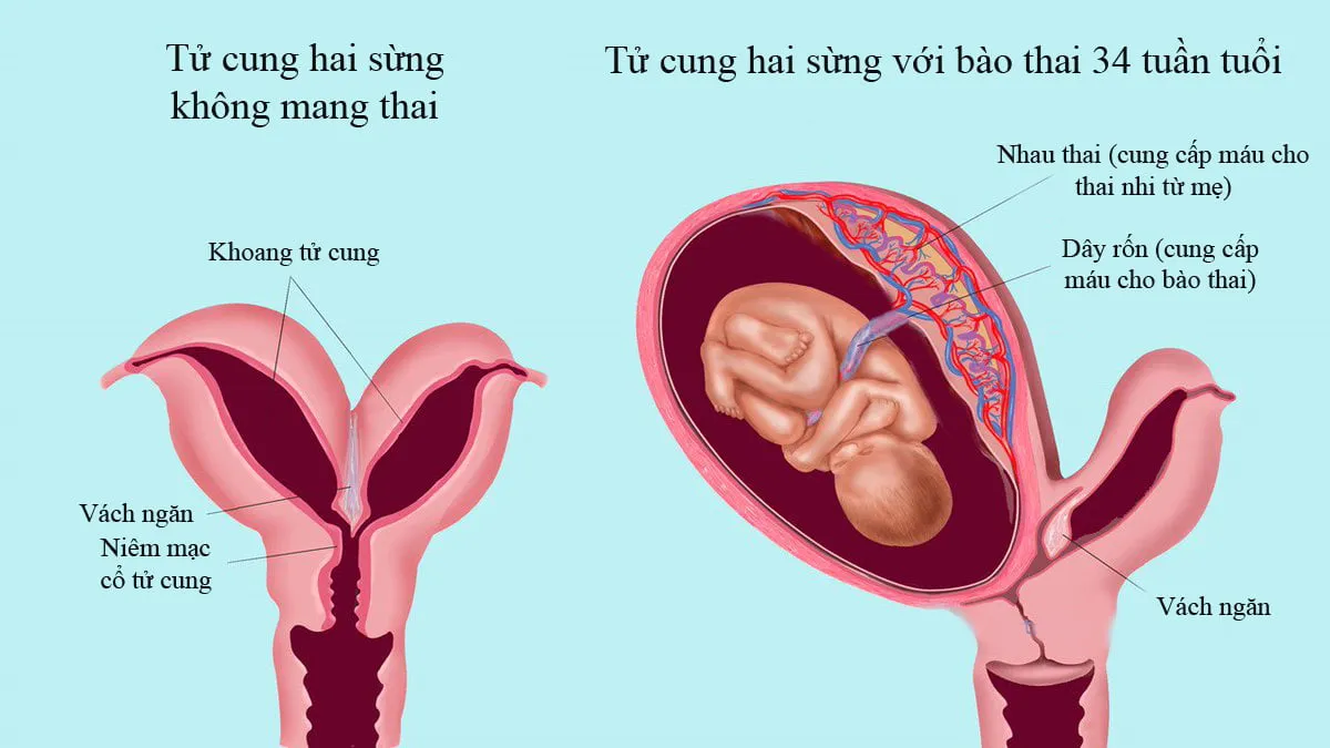 Tử cung hai sừng khi mang thai – Những điều bạn cần biết