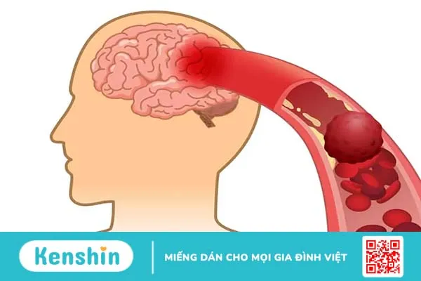 Tụ máu não là gì? Nguyên nhân, triệu chứng và điều trị