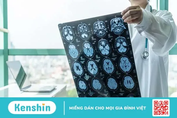 Tụ máu não là gì? Nguyên nhân, triệu chứng và điều trị