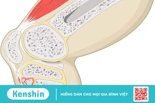 Tự nhiên bị đau khớp gối: nguyên nhân và cách điều trị